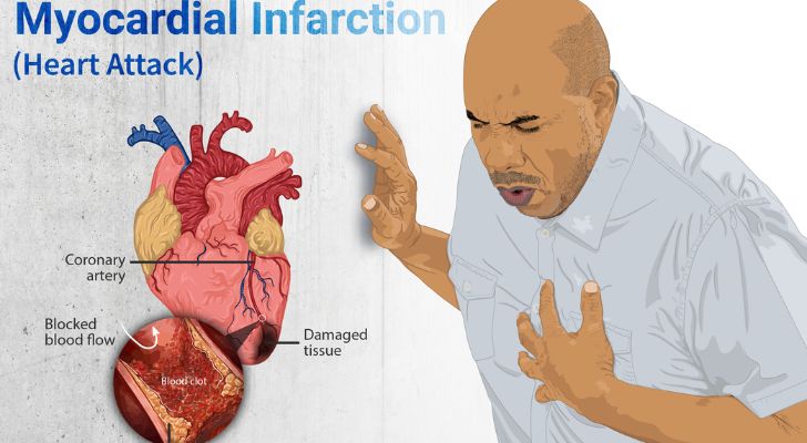 Essential Information on Heart Attacks for Seniors and Caregivers